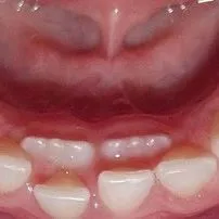 dente permanente nascendo torto