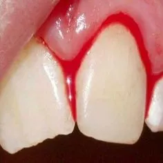 Traumatismo Dentário