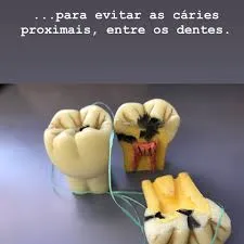 Cáries proximais