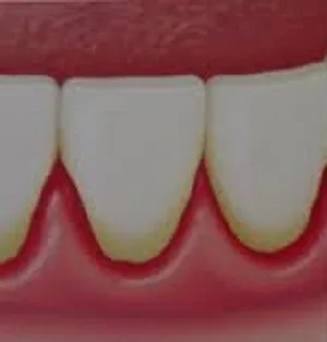 Biofilme dental