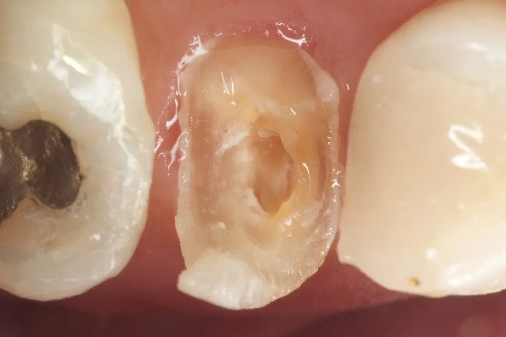 Dente molar quebrado