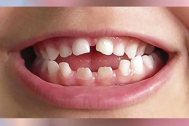 Dentição irregular