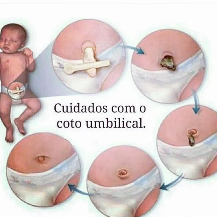 coto umbilical