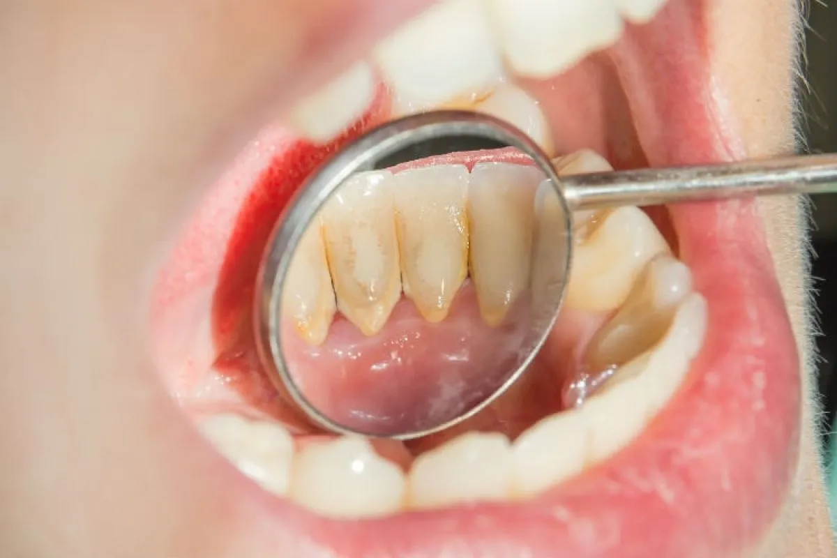 tipos de limpeza de dente