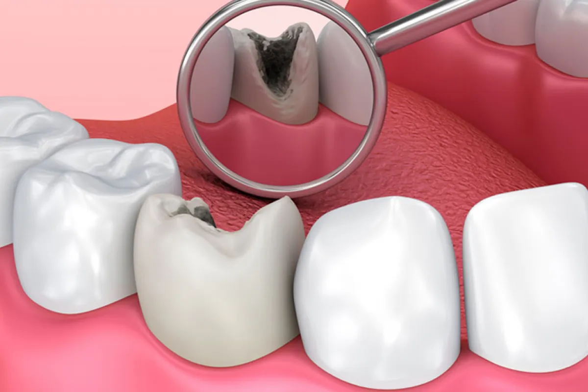 dente com cárie tem cura