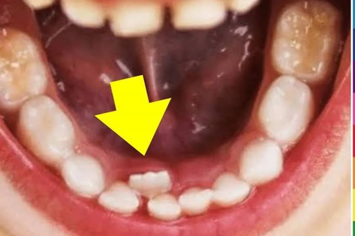 dente de leite não caiu