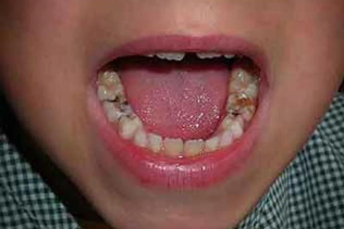 dente podre faz mal