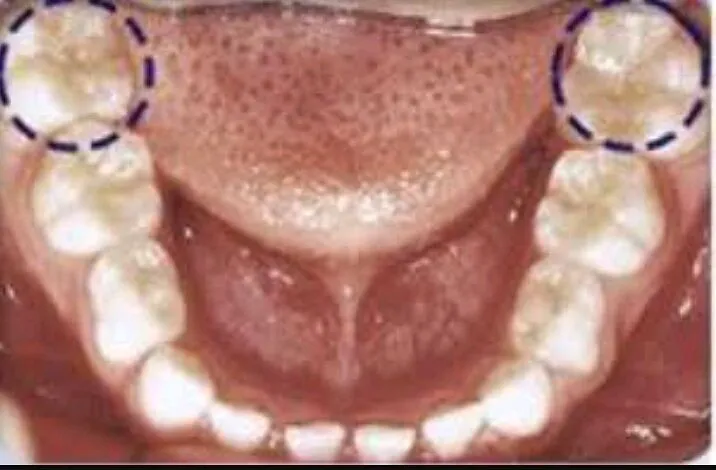 Primeiro molar permanente