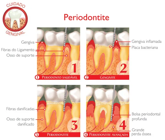 Periodontite e doenças