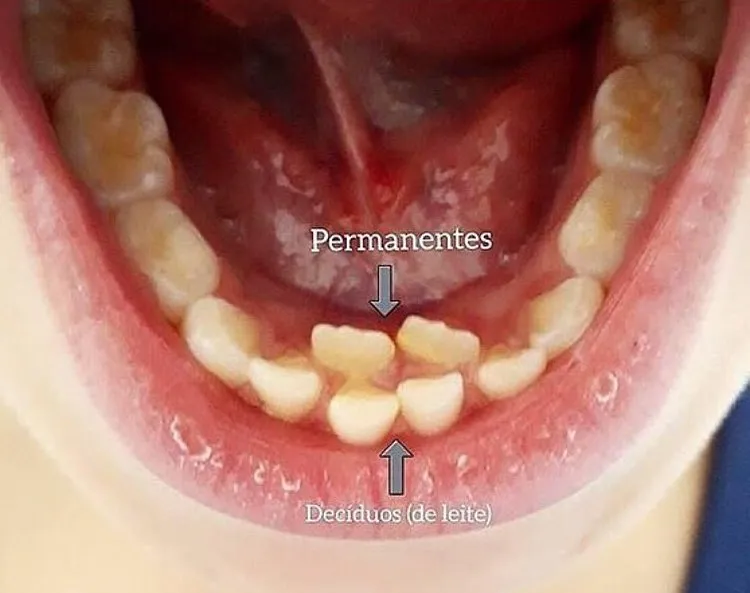 dente nascendo torto