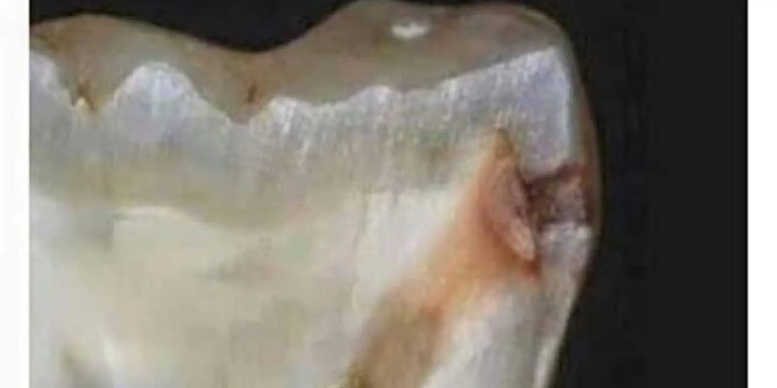 mau cheiro dente canal