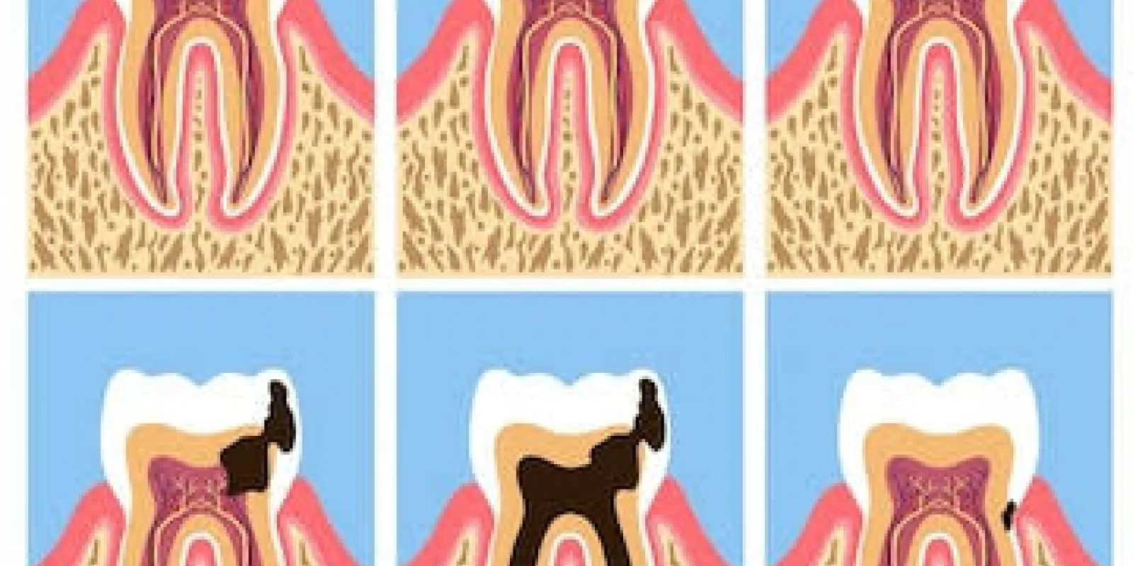 Dentes de leite cariados precisam ser tratados?