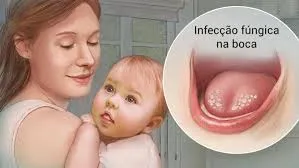 Sapinho