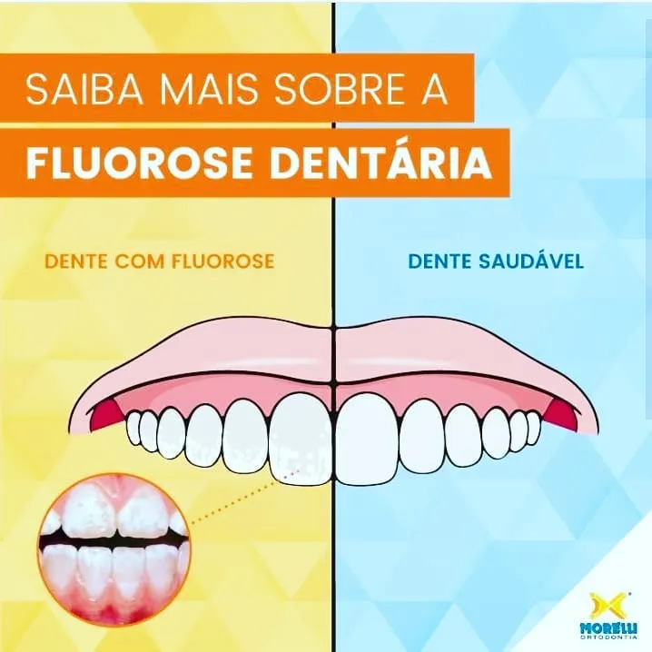 fluorose dental