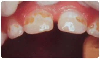 Dente amarelo
