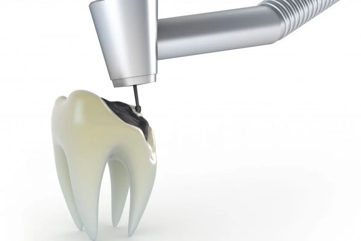 Dente de leite furado e preto