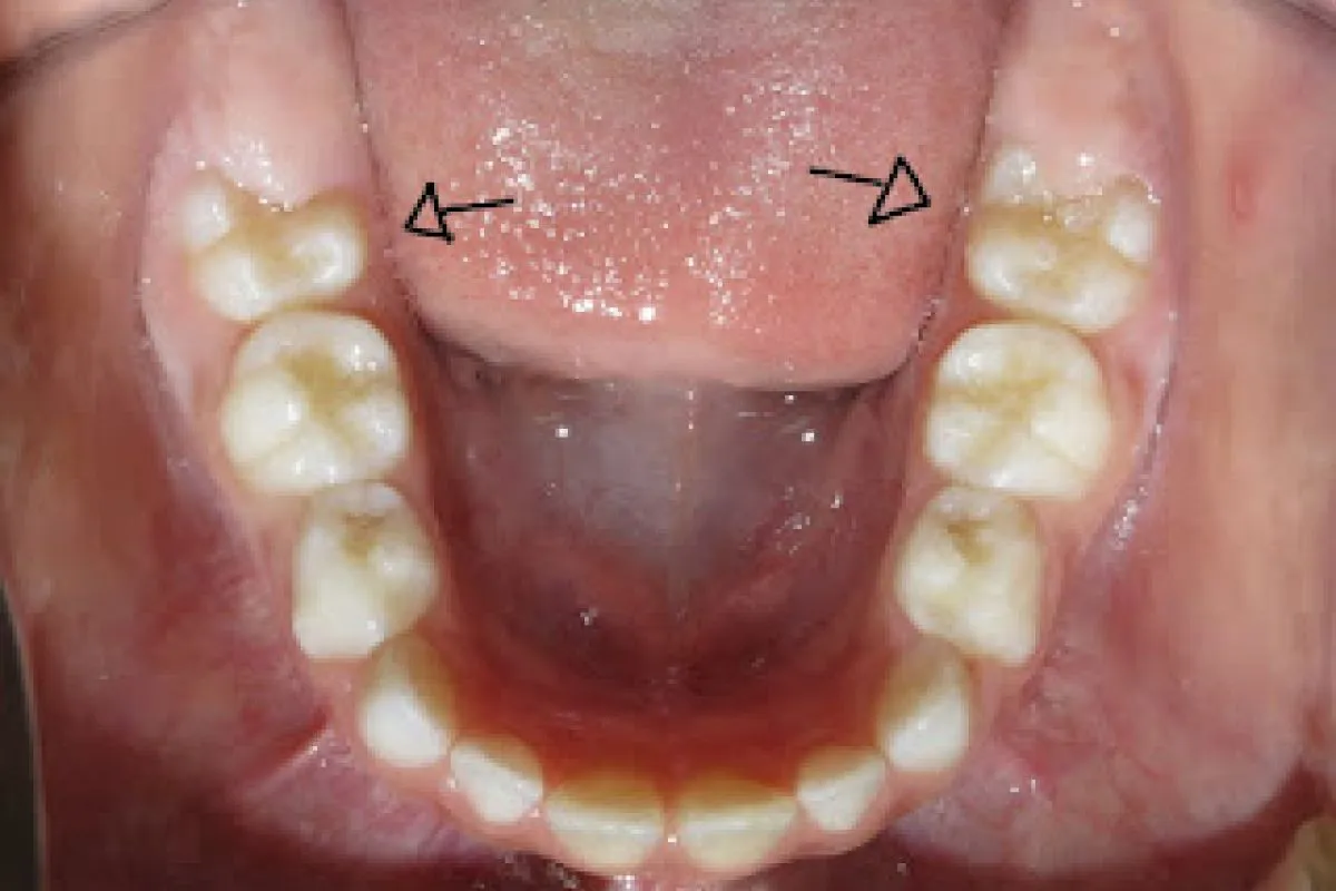 Gengiva inchada e dolorida no último dente